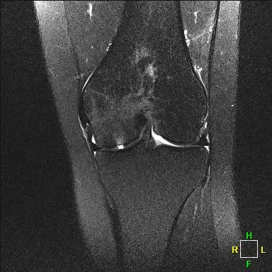 Hasta 2 AP radyografi, 3. ay sonrası